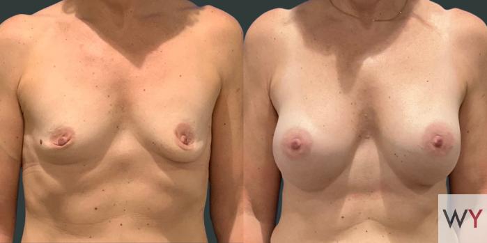 Breast Augmentation Before and After