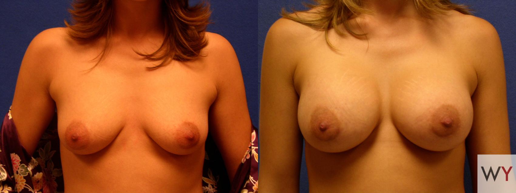 Before & After Breast Augmentation Case 64 View #1 View in Sacramento, Granite Bay, & Roseville, CA