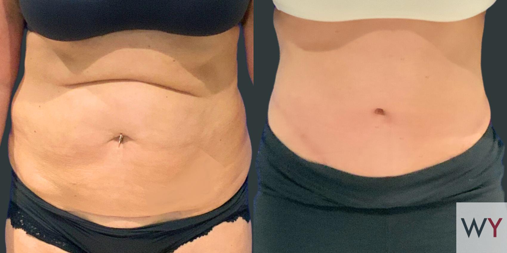 Tummy Tuck before and after photos