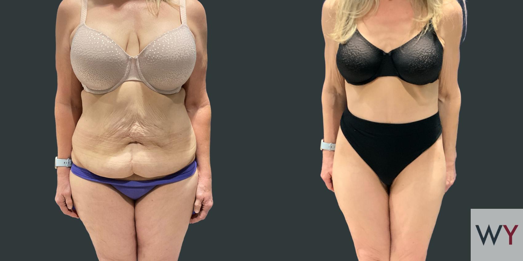 Tummy Tuck before and after