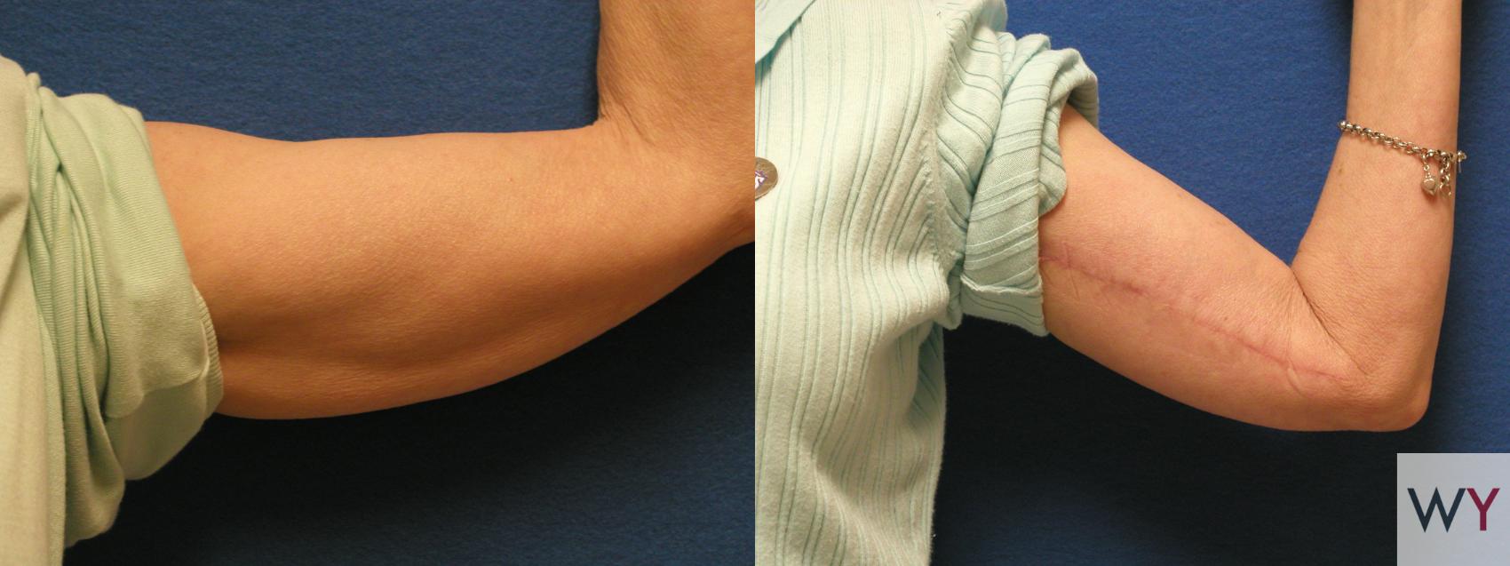 Before & After Arm Lift (Brachioplasty) Case 91 View #1 View in Sacramento, Granite Bay, & Roseville, CA