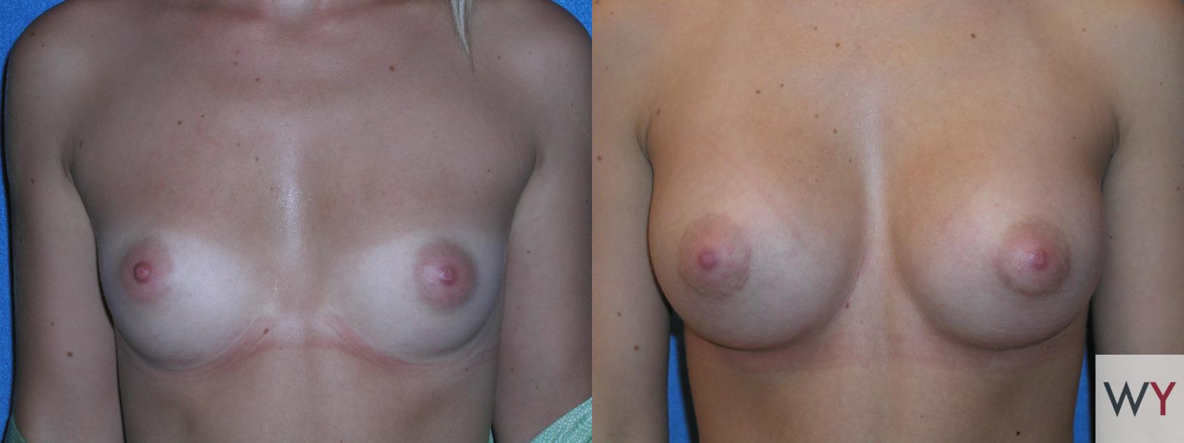 Before & After Breast Augmentation Case 103 View #1 View in Sacramento, Granite Bay, & Roseville, CA