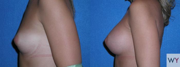Before & After Breast Augmentation Case 103 View #2 View in Sacramento, Granite Bay, & Roseville, CA
