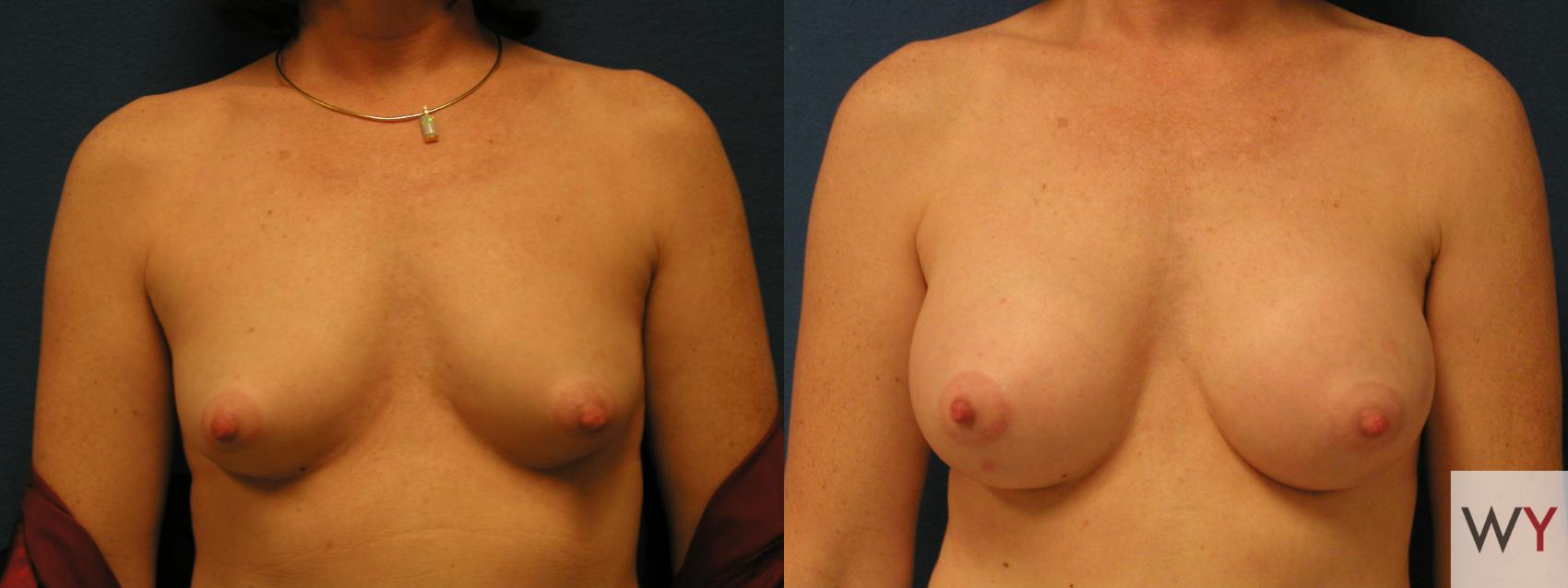 Before & After Breast Augmentation Case 104 View #1 View in Sacramento, CA
