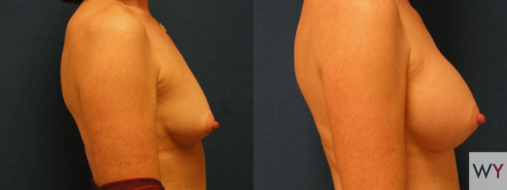 Before & After Breast Augmentation Case 104 View #2 View in Sacramento, CA
