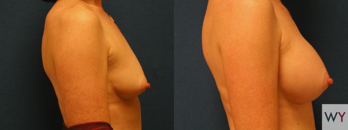 Before & After Breast Augmentation Case 104 View #2 View in Sacramento, Granite Bay, & Roseville, CA