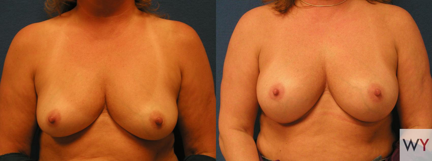 Before & After Breast Augmentation Case 106 View #1 View in Sacramento, Granite Bay, & Roseville, CA