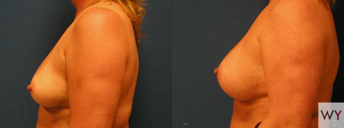 Before & After Breast Augmentation Case 106 View #2 View in Sacramento, Granite Bay, & Roseville, CA