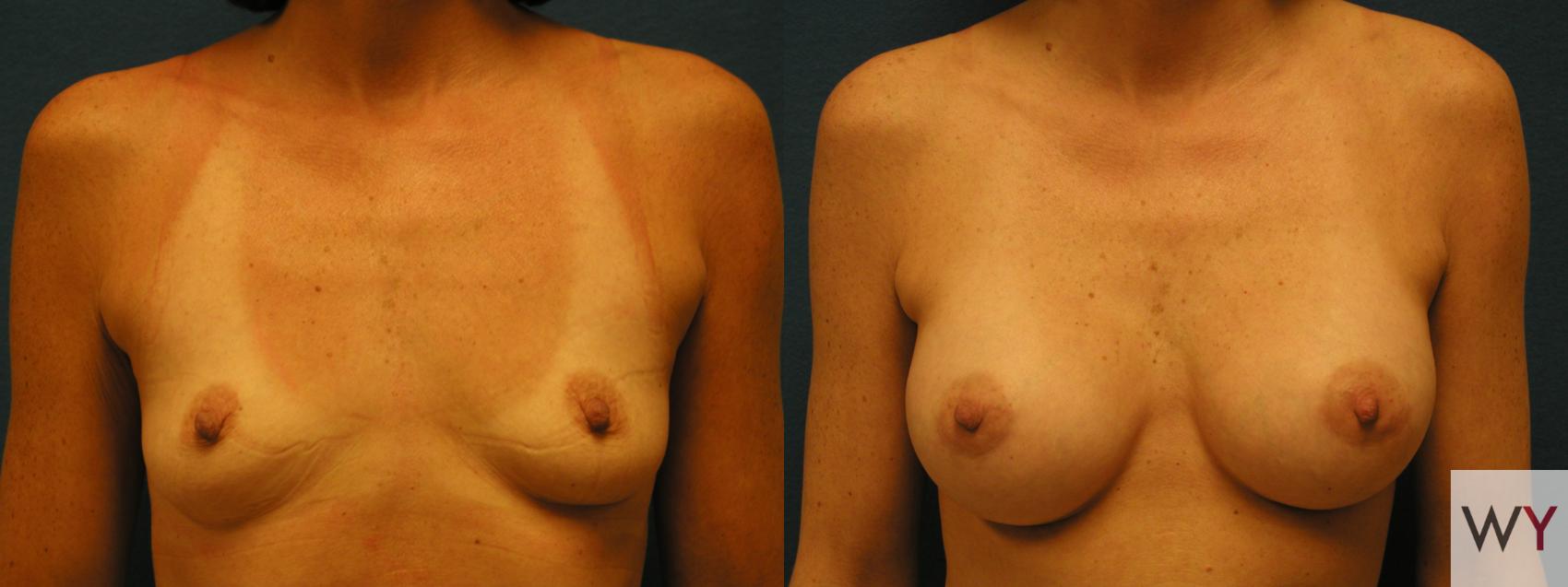 Before & After Breast Augmentation Case 111 View #1 View in Sacramento, CA