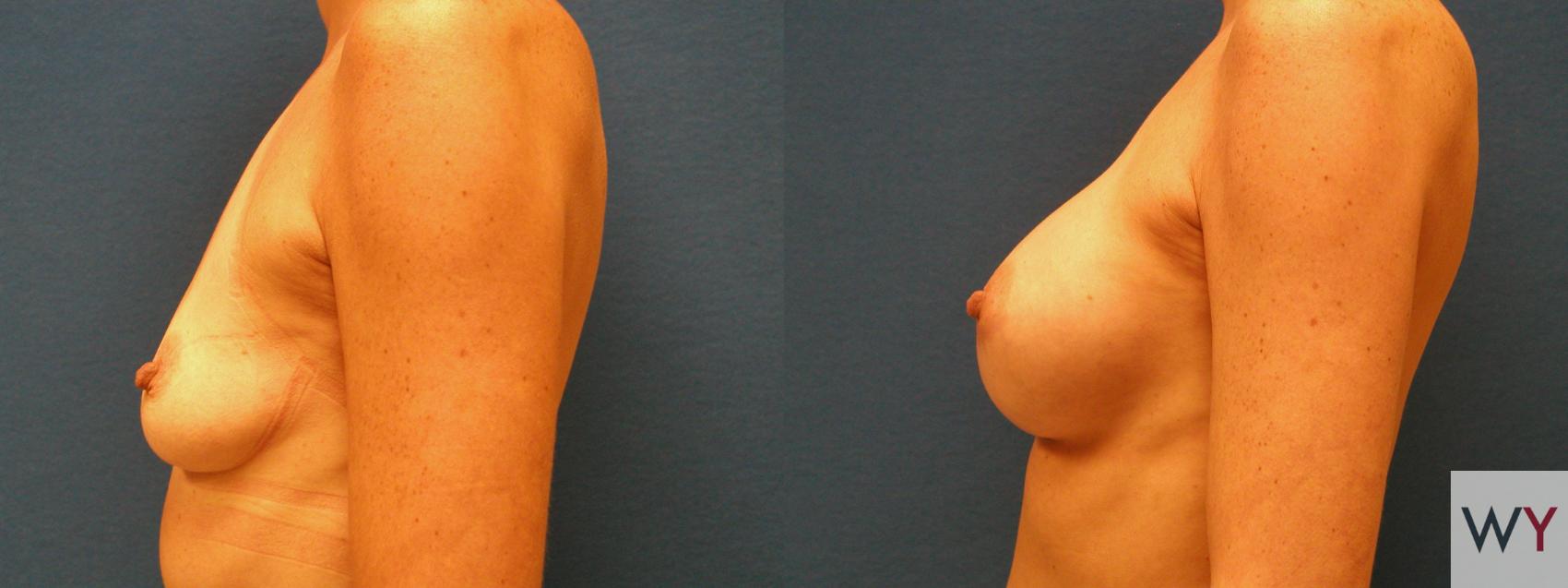Before & After Breast Augmentation Case 111 View #2 View in Sacramento, CA