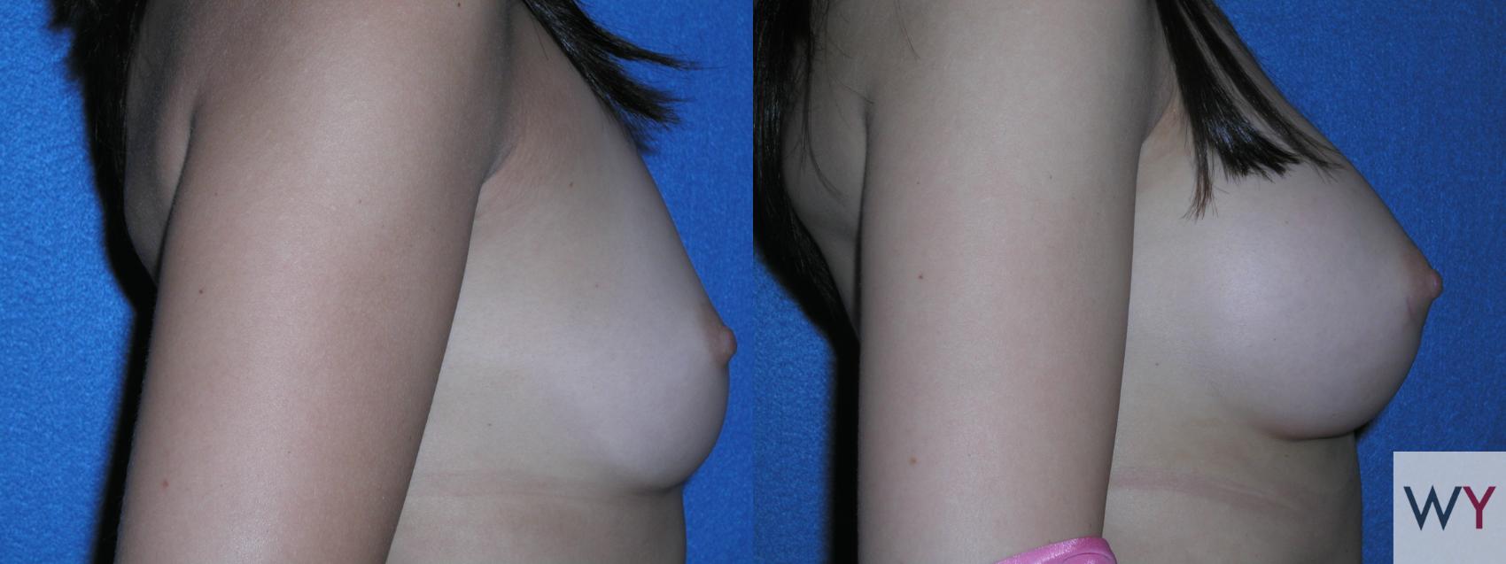 Before & After Breast Augmentation Case 126 View #2 View in Sacramento, CA