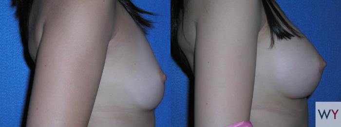 Before & After Breast Augmentation Case 126 View #2 View in Sacramento, Granite Bay, & Roseville, CA