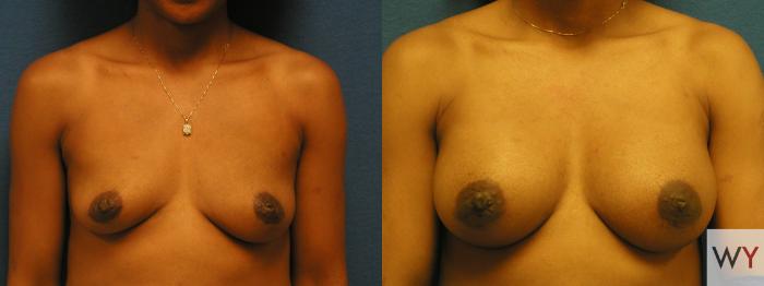 Before & After Breast Augmentation Case 140 View #1 View in Sacramento, Granite Bay, & Roseville, CA