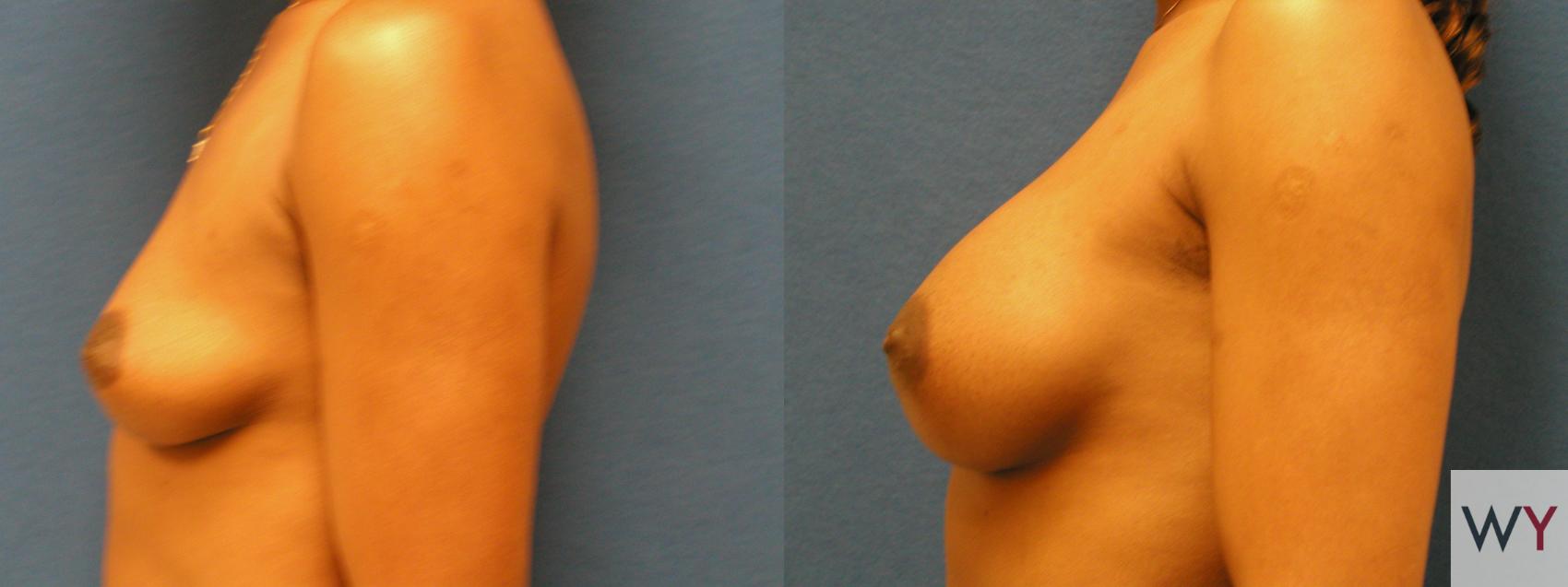 Before & After Breast Augmentation Case 140 View #2 View in Sacramento, CA