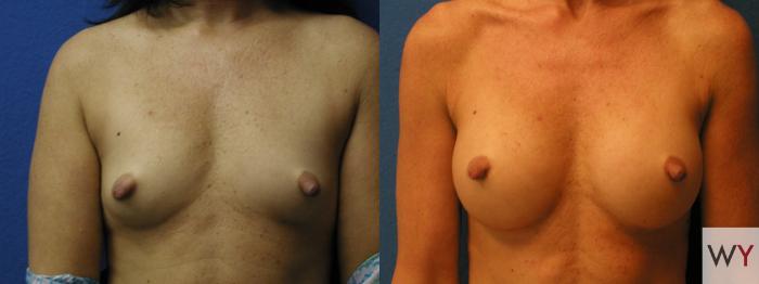 Before & After Breast Augmentation Case 141 View #1 View in Sacramento, Granite Bay, & Roseville, CA