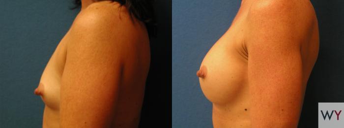 Before & After Breast Augmentation Case 141 View #2 View in Sacramento, Granite Bay, & Roseville, CA