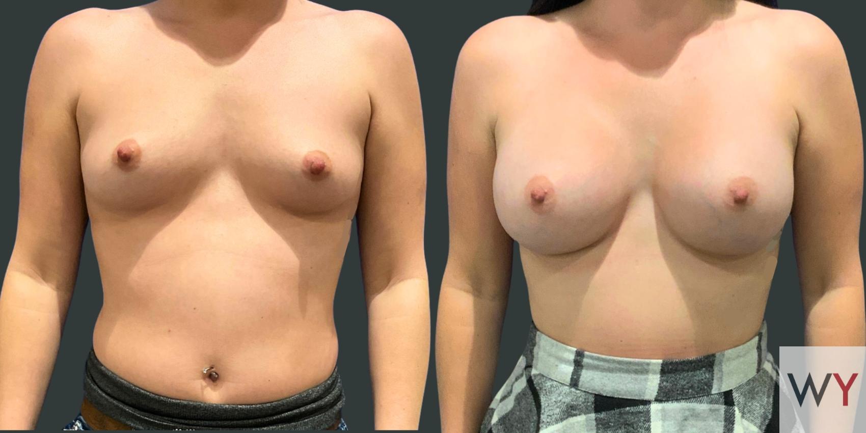 Breast Augmentation Before and After