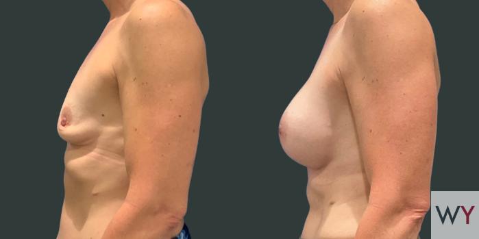 Breast Augmentation Before and After