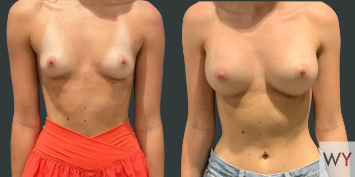 Breast Augmentation Before and After photos