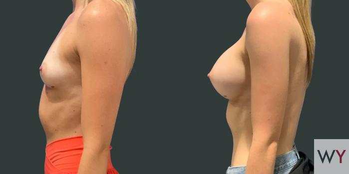 Breast Augmentation Before and After photos