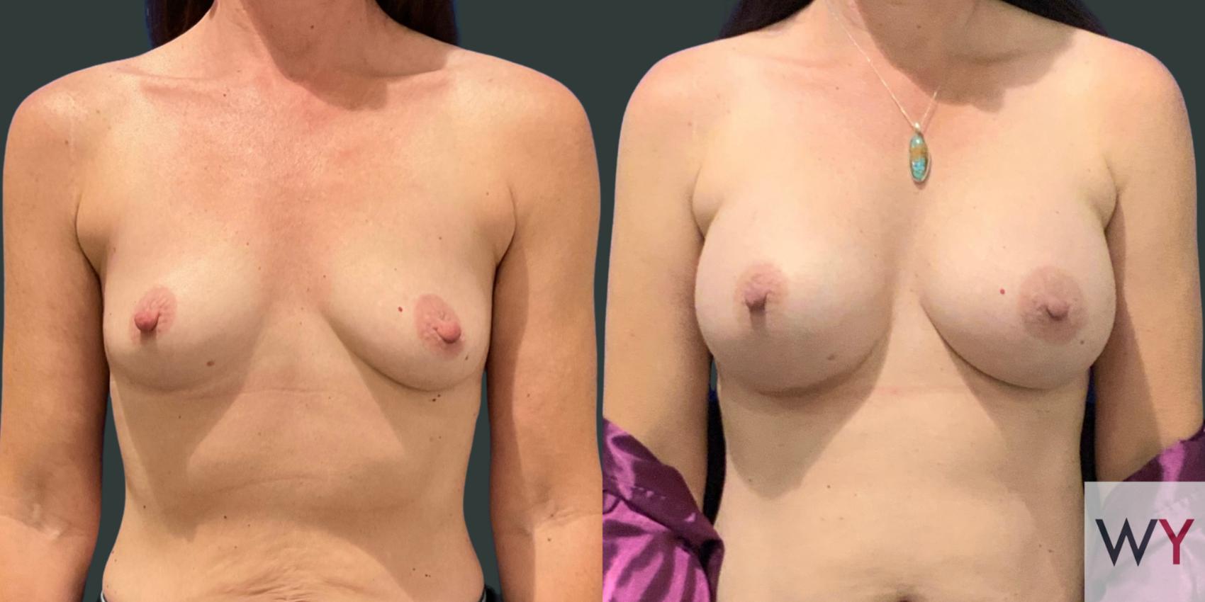 Breast Augmentation Before and After photos