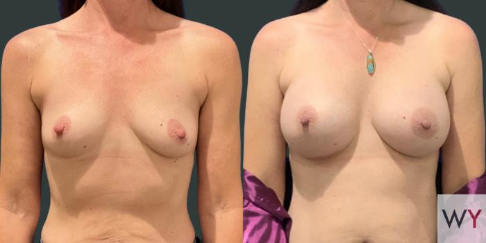 Breast Augmentation Before and After photos