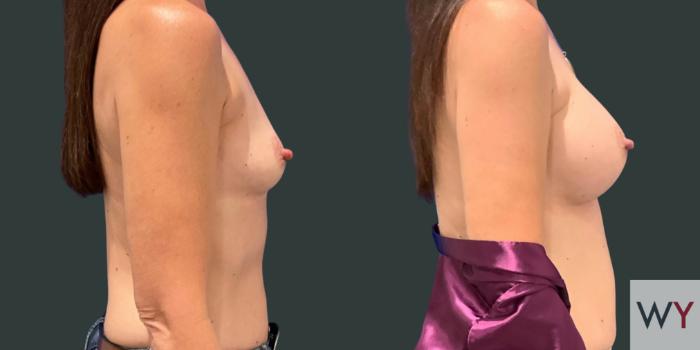 Breast Augmentation Before and After photos right side