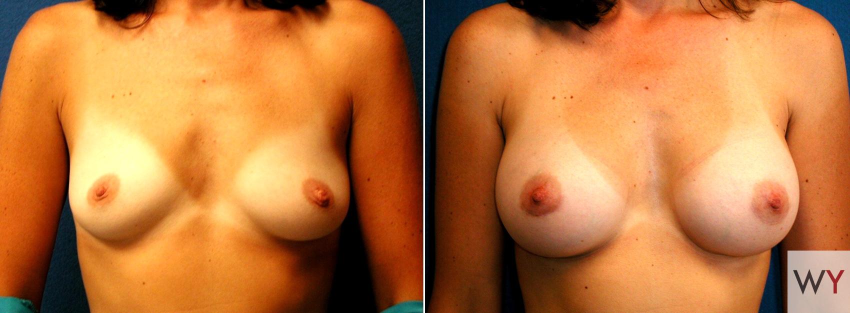 Before & After Breast Augmentation Case 58 View #1 View in Sacramento, CA