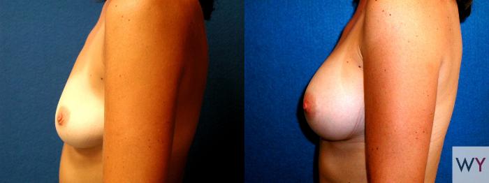 Before & After Breast Augmentation Case 58 View #2 View in Sacramento, Granite Bay, & Roseville, CA