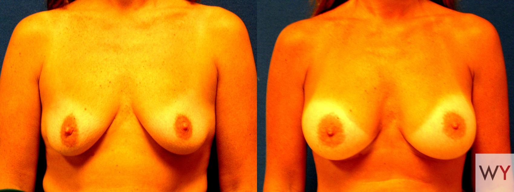 Before & After Breast Augmentation Case 59 View #1 View in Sacramento, Granite Bay, & Roseville, CA