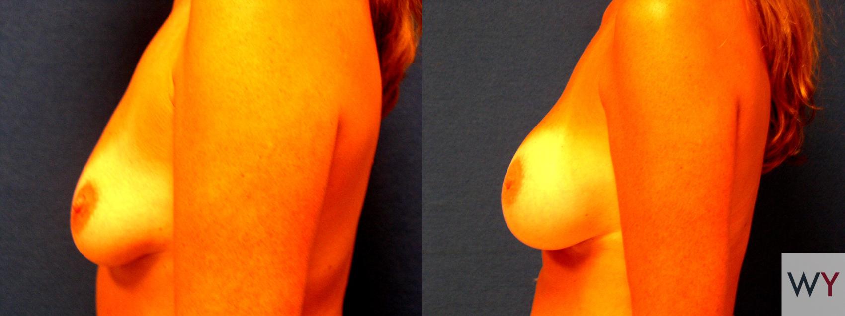Before & After Breast Augmentation Case 59 View #2 View in Sacramento, CA