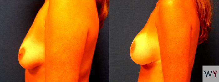 Before & After Breast Augmentation Case 59 View #2 View in Sacramento, Granite Bay, & Roseville, CA