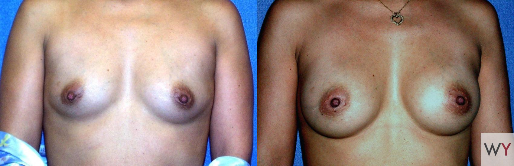 Before & After Breast Augmentation Case 60 View #1 View in Sacramento, CA