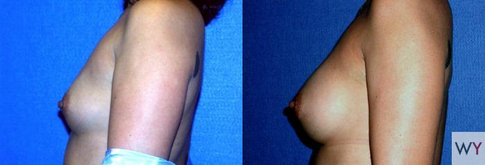 Before & After Breast Augmentation Case 60 View #2 View in Sacramento, Granite Bay, & Roseville, CA