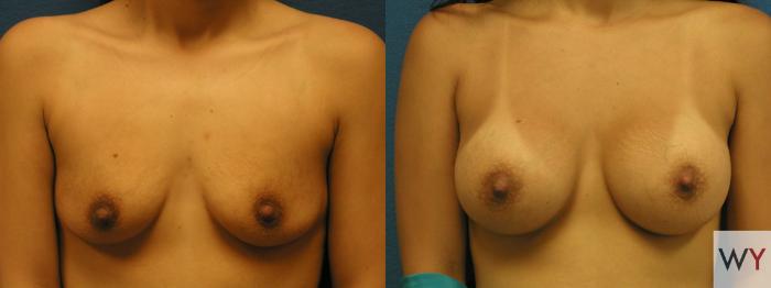Before & After Breast Augmentation Case 61 View #1 View in Sacramento, Granite Bay, & Roseville, CA