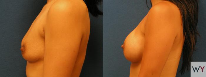 Before & After Breast Augmentation Case 61 View #2 View in Sacramento, Granite Bay, & Roseville, CA