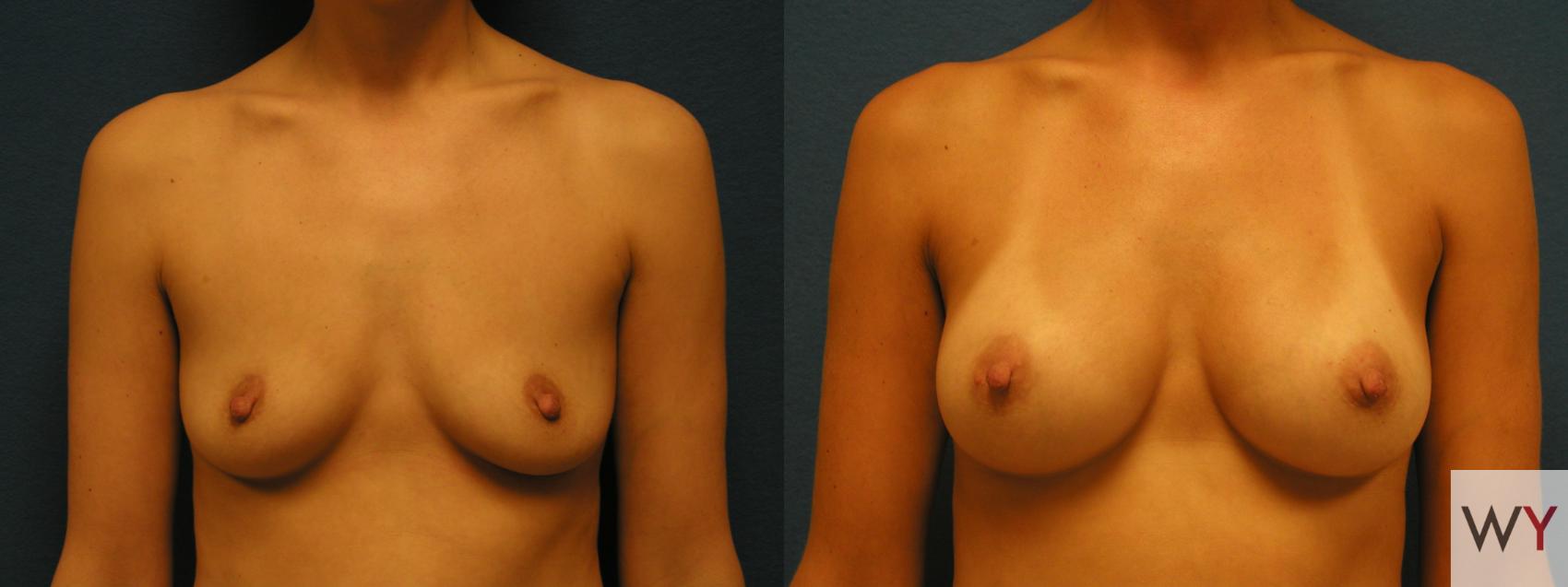 Before & After Breast Augmentation Case 62 View #1 View in Sacramento, CA