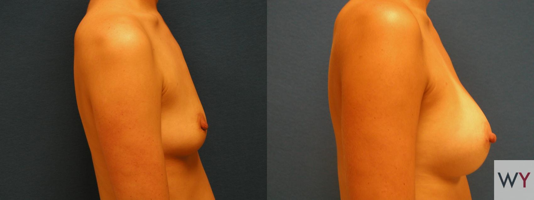 Before & After Breast Augmentation Case 62 View #2 View in Sacramento, CA