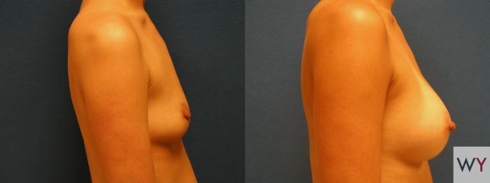 Before & After Breast Augmentation Case 62 View #2 View in Sacramento, Granite Bay, & Roseville, CA