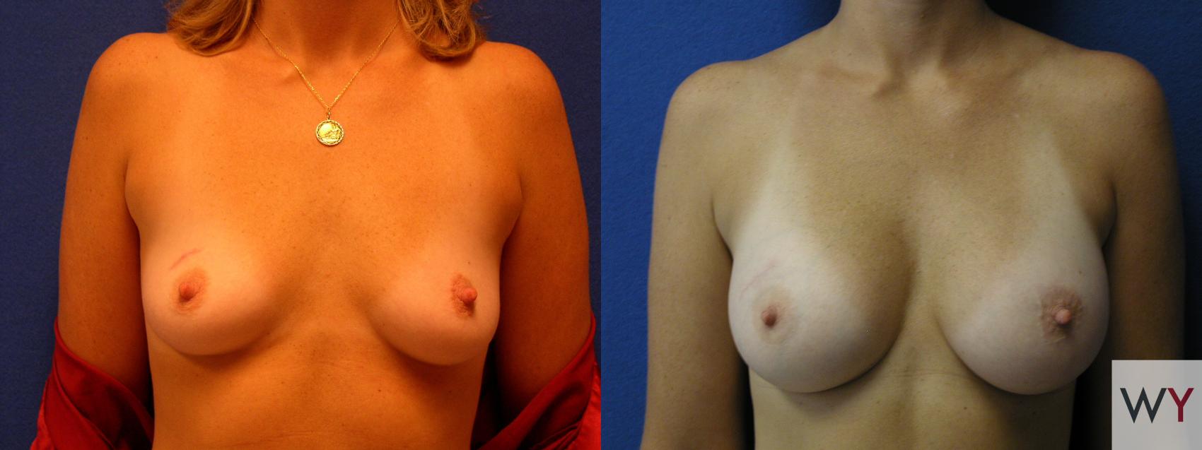 Before & After Breast Augmentation Case 63 View #1 View in Sacramento, Granite Bay, & Roseville, CA