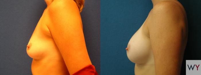 Before & After Breast Augmentation Case 63 View #2 View in Sacramento, Granite Bay, & Roseville, CA