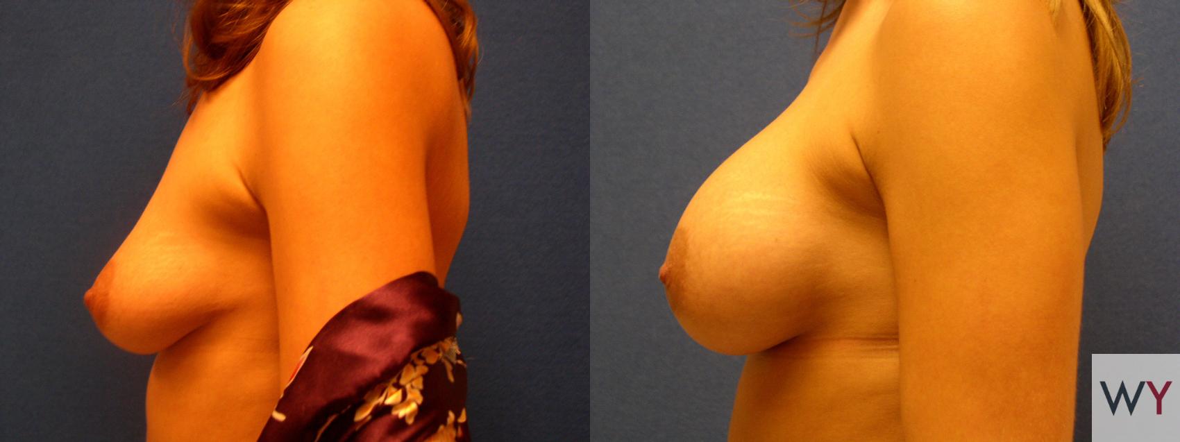Before & After Breast Augmentation Case 64 View #2 View in Sacramento, CA