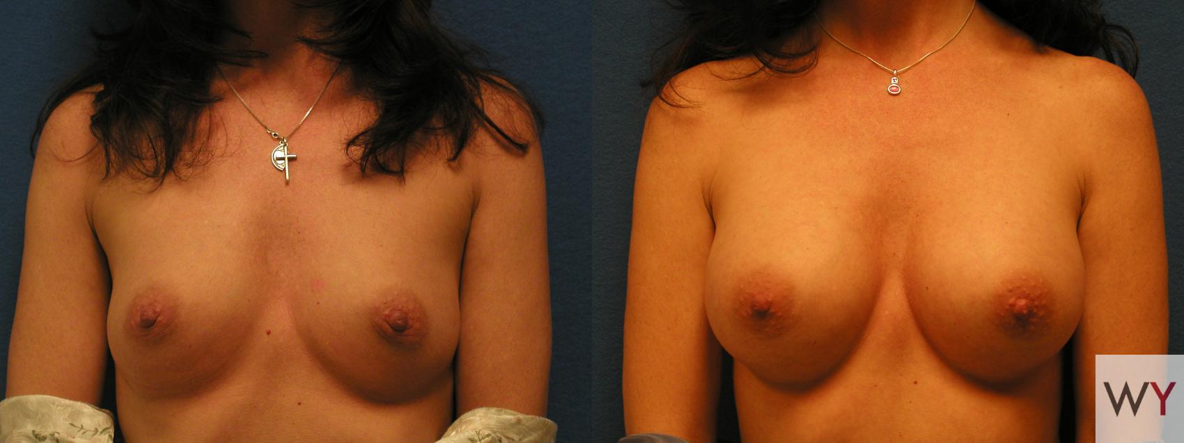 Before & After Breast Augmentation Case 65 View #1 View in Sacramento, CA
