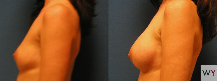Before & After Breast Augmentation Case 65 View #2 View in Sacramento, CA