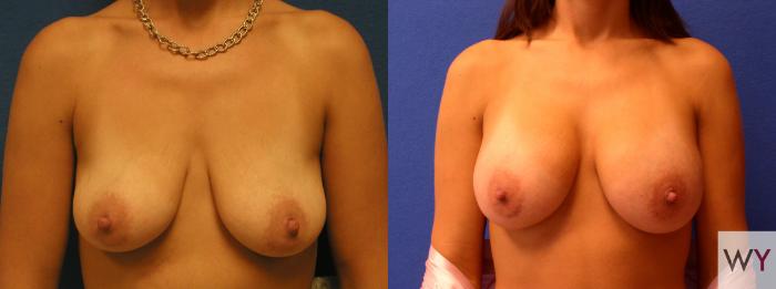 Before & After Breast Augmentation Case 66 View #1 View in Sacramento, Granite Bay, & Roseville, CA
