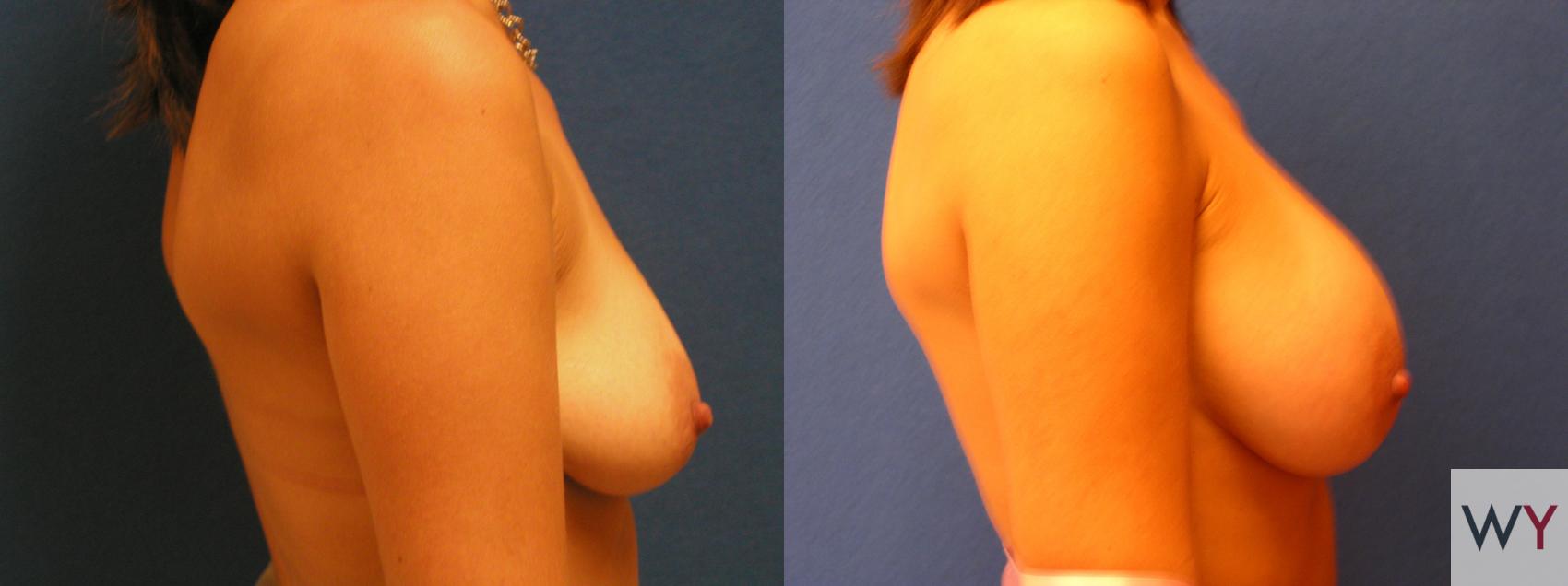 Before & After Breast Augmentation Case 66 View #2 View in Sacramento, CA