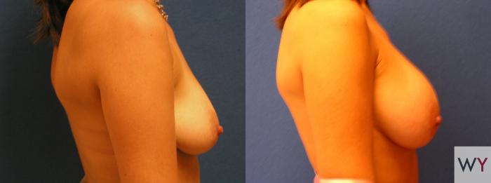 Before & After Breast Augmentation Case 66 View #2 View in Sacramento, Granite Bay, & Roseville, CA