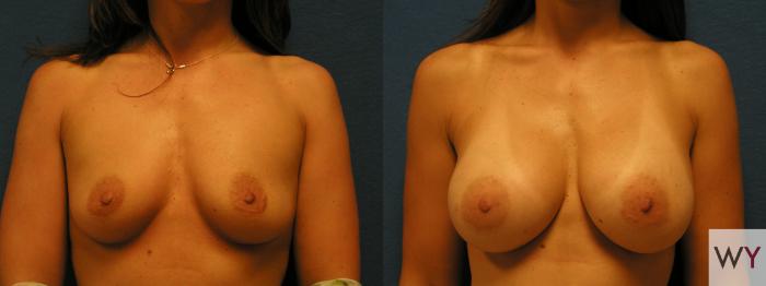 Before & After Breast Augmentation Case 67 View #1 View in Sacramento, CA