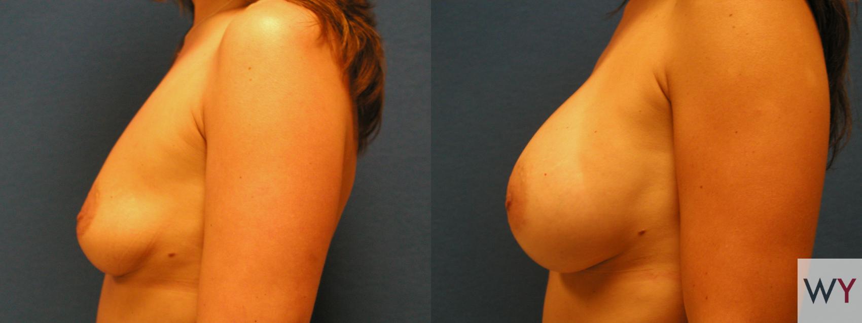 Before & After Breast Augmentation Case 67 View #2 View in Sacramento, CA