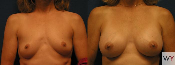 Before & After Breast Augmentation Case 83 View #1 View in Sacramento, Granite Bay, & Roseville, CA